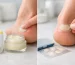 Blister Balm vs Blister Plasters: Which Works?